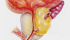 Efectos del cáncer de próstata: la disfunción eréctil e incontinencia urinaria.