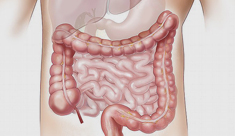 Después del cáncer colorrectal y la ostomía: superando nuevos retos