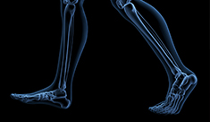 miniatura-osteoporosi