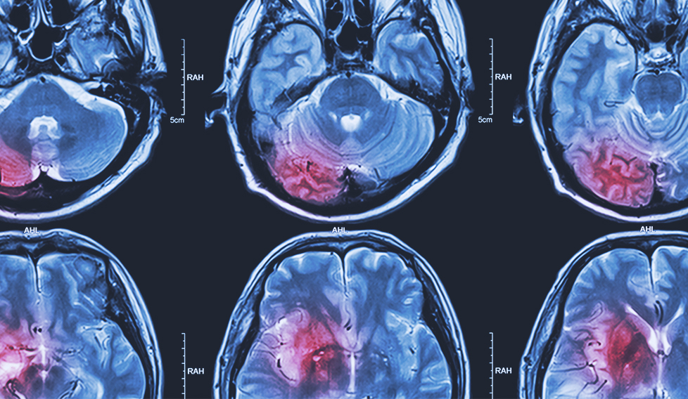 despres-dun-tumor-cerebral