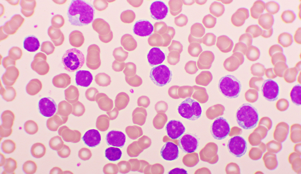 la-vida-despres-de-la-leucemia-limfocitica-cronica-llc